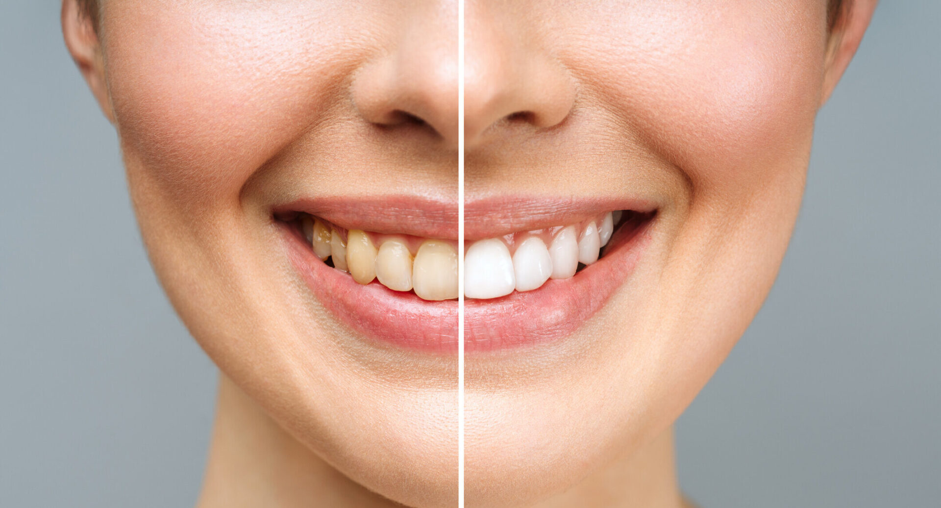 blanqueamiento dental en villa carlos paz